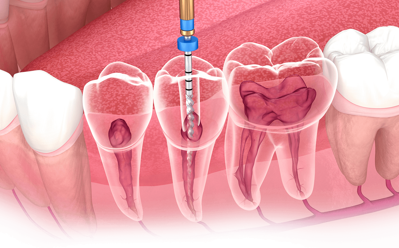 Zahnarzt Berlin - Endodontie, Wurzelbehandlung